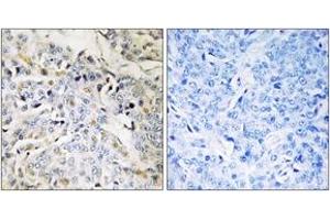 Immunohistochemistry analysis of paraffin-embedded human breast carcinoma tissue, using RBM34 Antibody. (RBM34 antibody  (AA 345-394))