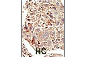 Formalin-fixed and paraffin-embedded human cancer tissue reacted with the primary antibody, which was peroxidase-conjugated to the secondary antibody, followed by DAB staining. (ACVR1 antibody  (AA 132-162))