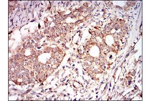 Immunohistochemical analysis of paraffin-embedded cervical cancer tissues using PRKAG1 mouse mAb with DAB staining. (PRKAG1 antibody  (AA 230-331))