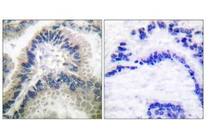 Immunohistochemical analysis of paraffin-embedded human lung carcinoma tissue using Guanylate Cyclase beta antibody (ABIN5976418).