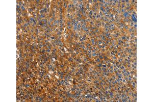 Immunohistochemistry of Human liver cancer using ORM2 Polyclonal Antibody at dilution of 1:40