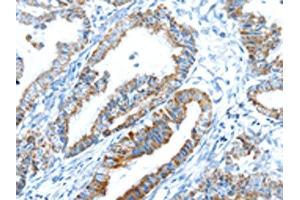 The image on the left is immunohistochemistry of paraffin-embedded Human esophagus cancer tissue using ABIN7192908(TRIM47 Antibody) at dilution 1/20, on the right is treated with synthetic peptide. (TRIM47 antibody)