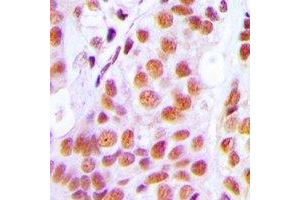 Immunohistochemical analysis of PRPF3 staining in human breast cancer formalin fixed paraffin embedded tissue section. (PRPF3 antibody)