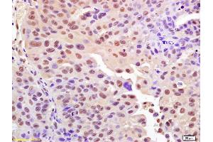 Formalin-fixed and paraffin embedded human bladder carcinoma labeled with Anti-Phospho-Histone H2A. (H2AFX antibody  (pSer140))