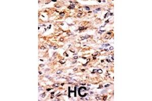 Formalin-fixed and paraffin-embedded human cancer tissue reacted with the primary antibody, which was peroxidase-conjugated to the secondary antibody, followed by AEC staining. (GCN2 antibody  (N-Term))