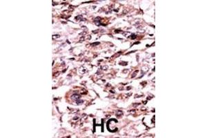Formalin-fixed and paraffin-embedded human cancer tissue reacted with the primary antibody, which was peroxidase-conjugated to the secondary antibody, followed by AEC staining. (ABL1 antibody  (pTyr245))