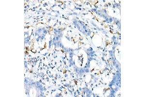 Immunohistochemistry of paraffin-embedded Human colon carcinoma using CD74 antibody (ABIN6128421, ABIN6138228, ABIN6138230 and ABIN6221316) at dilution of 1:25 (40x lens).