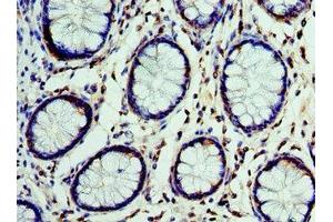 Immunohistochemistry of paraffin-embedded human colon cancer using ABIN7149003 at dilution of 1:100 (CST7 antibody  (AA 20-145))