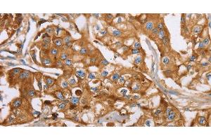 Immunohistochemistry of paraffin-embedded Human breast cancer using LTF Polyclonal Antibody at dilution of 1:40 (Lactoferrin antibody)