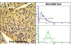 (LEFT)Formalin-fixed and paraffin-embedded human lung carcinoma with EPB41L4B Antibody (C-term), which was peroxidase-conjugated to the secondary antibody, followed by DAB staining. (EPB41L4B antibody  (C-Term))