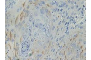 DAB staining on IHC-P; Samples: Human Skin cancer Tissue (BCAM antibody  (AA 32-257))
