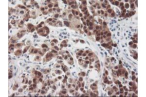 Immunohistochemical staining of paraffin-embedded Carcinoma of Human lung tissue using anti-HSPBP1 mouse monoclonal antibody. (HSPBP1 antibody)