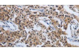 Immunohistochemistry of paraffin-embedded Human lung cancer tissue using PDCD7 Polyclonal Antibody at dilution 1:60 (PDCD7 antibody)