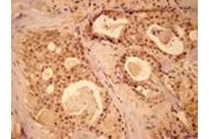 Immunohistochemistry analysis of human breast cancer tissue with MEK1 pAb. (MEK1 antibody  (N-Term))