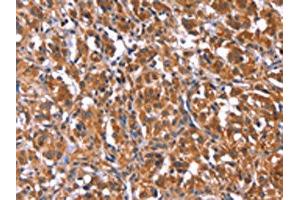 The image on the left is immunohistochemistry of paraffin-embedded Human thyroid cancer tissue using ABIN7192753(TDP2 Antibody) at dilution 1/40, on the right is treated with synthetic peptide.