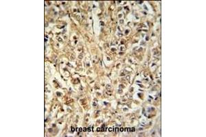 DDX6 Antibody (Center) (ABIN653855 and ABIN2843115) IHC analysis in formalin fixed and paraffin embedded breast carcinoma followed by peroxidase conjugation of the secondary antibody and DAB staining. (DDX6 antibody  (AA 348-375))