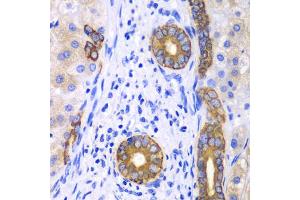 Immunohistochemistry of paraffin-embedded human liver cancer using KRT19 antibody (ABIN5970077) at dilution of 1/100 (40x lens).