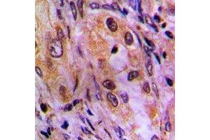 Immunohistochemical analysis of AKR1C2 staining in human lung cancer formalin fixed paraffin embedded tissue section. (AKR1C2 antibody)