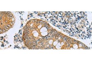 Immunohistochemistry of paraffin-embedded Human colorectal cancer tissue using GUCA1A Polyclonal Antibody at dilution of 1:105(x200) (GCAP1 antibody)