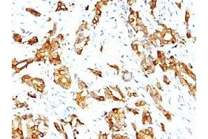 Formalin-fixed, paraffin-embedded human breast carcinoma stained with HSP27 antibody (SPM252) (HSP27 antibody)