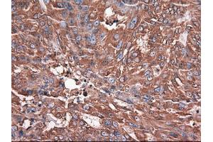 Immunohistochemical staining of paraffin-embedded Adenocarcinoma of breast using anti-CPA1 (ABIN2452647) mouse monoclonal antibody. (CPA1 antibody  (AA 1-419))