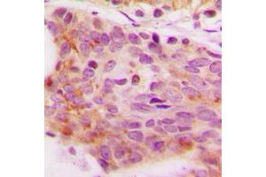 Immunohistochemical analysis of NFAT4 (pS165) staining in human breast cancer formalin fixed paraffin embedded tissue section. (NFATC3 antibody  (N-Term, pSer165))
