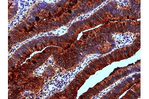 Immunohistochemistry staining of human colon adenocarcinoma (paraffin-embedded sections) with anti-Blood Group Lewis a (7LE). (Blood Group Lewis A antibody)