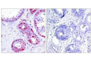 Immunohistochemical analysis of paraffin-embedded human breast carcinoma tissue using c-Jun(Phospho-Ser243) Antibody(left) or the same antibody preincubated with blocking peptide(right). (C-JUN antibody  (pSer243))