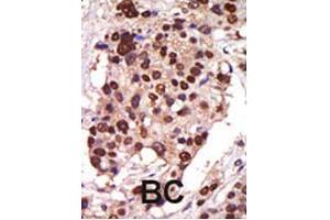 Formalin-fixed and paraffin-embedded human cancer tissue reacted with the PRKD3 polyclonal antibody  , which was peroxidase-conjugated to the secondary antibody, followed by AEC staining . (PRKD3 antibody  (Internal Region))
