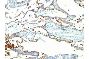 Formalin-fixed, paraffin-embedded human Lung Carcinoma stained with Milk Fat Globule Monoclonal Antibody (SPM291) (MFGE8 antibody)