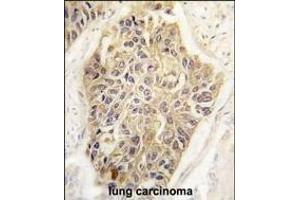 Forlin-fixed and paraffin-embedded hun lung carcino tissue reacted with GEA1 Antibody (Center) (ABIN390105 and ABIN2840617) , which was peroxidase-conjugated to the secondary antibody, followed by DAB staining. (MAGEA1 antibody  (AA 143-173))