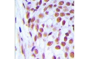 Immunohistochemical analysis of DNA Ligase 1 staining in human breast cancer formalin fixed paraffin embedded tissue section. (LIG1 antibody  (N-Term))