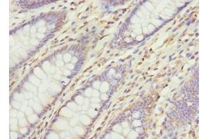 Immunohistochemistry of paraffin-embedded human colon cancer using ABIN7175357 at dilution of 1:100 (Vangl1 antibody  (AA 275-524))