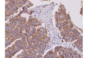 IHC-P Image Immunohistochemical analysis of paraffin-embedded human gastric cancer, using Cofilin 2, antibody at 1:100 dilution. (Cofilin 2 antibody  (C-Term))