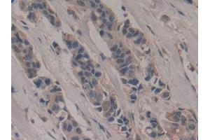 IHC-P analysis of Human Breast cancer Tissue, with DAB staining. (Poliovirus Receptor antibody  (AA 56-309))