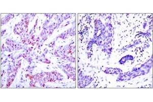 Immunohistochemistry analysis of paraffin-embedded human breast carcinoma, using ATF4 (Ab-245) Antibody.