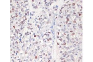 Immunohistochemistry of paraffin-embedded Human gastric cancer using Phospho-γH2A. (gamma H2AX antibody  (pSer139))