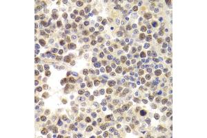 Immunohistochemistry of paraffin-embedded human B cell lymphoma using MCM4 Antibody (ABIN5971548) at dilution of 1/200 (40x lens).