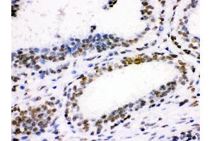 Anti- CDK1 Picoband antibody, IHC(P) IHC(P): Human Mammary Cancer Tissue (CDK1 antibody  (AA 66-297))