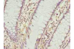 Immunohistochemistry of paraffin-embedded human colon cancer using ABIN7163544 at dilution of 1:100 (PLGRKT antibody  (AA 1-147))
