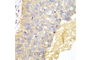 Immunohistochemistry of paraffin-embedded human lung cancer using EPCAM antibody (ABIN5970523) at dilution of 1/100 (40x lens). (EpCAM antibody)