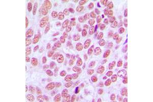 Immunohistochemical analysis of CCDC102B staining in human breast cancer formalin fixed paraffin embedded tissue section. (CCDC102B antibody  (Center))