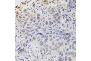 Immunohistochemistry of paraffin-embedded human esophageal cancer using HDGF Antibody.