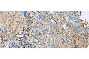 Immunohistochemistry of paraffin-embedded Human cervical cancer tissue using HLA-DPB1 Polyclonal Antibody at dilution of 1:50(x200) (HLA-DPB1 antibody)