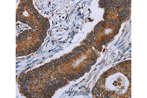 Immunohistochemistry of Human colon cancer using IDH2 Polyclonal Antibody at dilution of 1:60