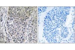 Immunohistochemistry analysis of paraffin-embedded human lung carcinoma tissue, using BRP16 Antibody. (FAM203B antibody  (AA 251-300))
