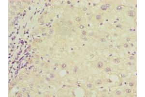 Immunohistochemistry of paraffin-embedded human liver cancer using ABIN7149150 at dilution of 1:100 (COX17 antibody  (AA 1-63))