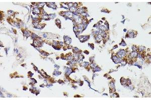 Immunohistochemistry of paraffin-embedded Human lung cancer using SUCLG2 Polyclonal Antibody at dilution of 1:100 (40x lens). (SUCLG2 antibody)