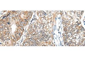 Immunohistochemistry of paraffin-embedded Human gastric cancer tissue using NADK2 Polyclonal Antibody at dilution of 1:40(x200) (NADK2 antibody)