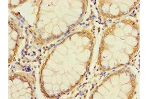 Immunohistochemistry of paraffin-embedded human colon cancer using ABIN7166269 at dilution of 1:100 (UNC93A antibody  (AA 374-415))